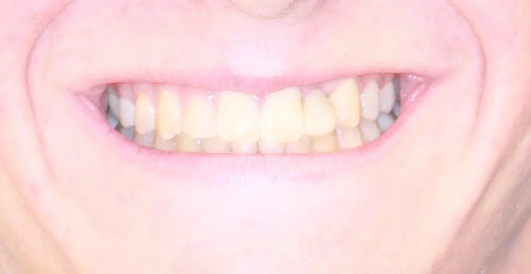 Missing and Peg Lateral Incisors