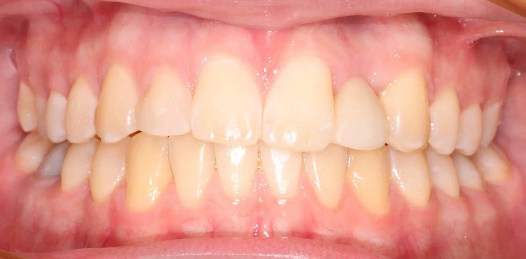 Missing and Peg Lateral Incisors