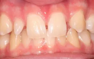 Missing and Peg Lateral Incisors