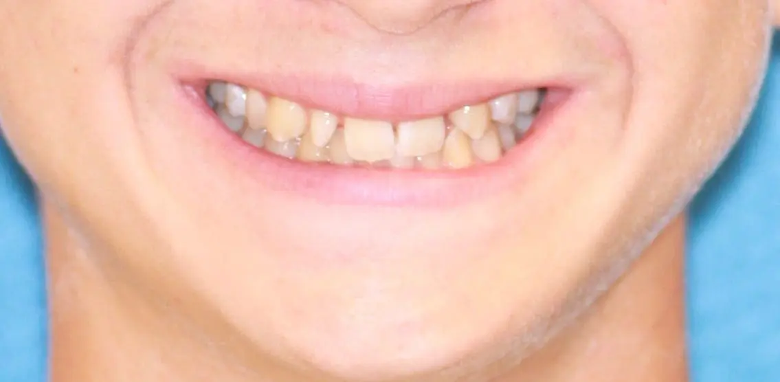 Missing and Peg Lateral Incisors